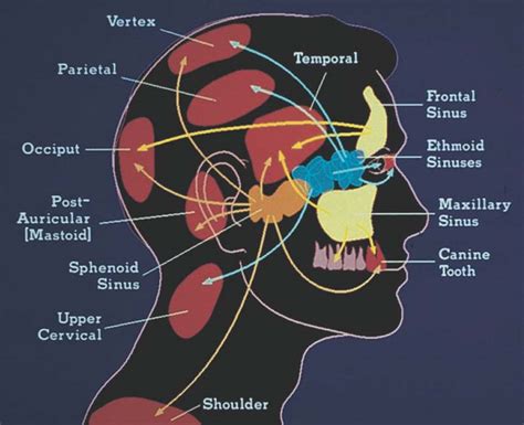 Frontal Sinus Headache