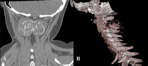Aneurysmal Bone Cyst In The Cervical Spine Bmj Case Reports