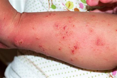 Cases Of Scabies In People Put Quintana Roo In The Spotlight The
