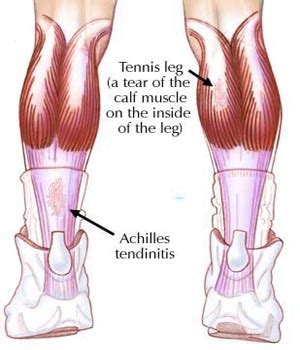 A tendon is band of tissue made up of many fibers. ACHILLES TENDONITIS (TENDINITIS) | Badminton Cafe
