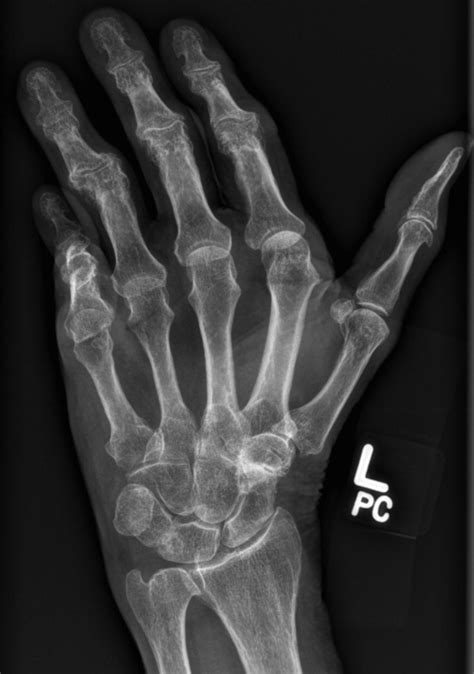 Dupeytrens Contracture Radiology At St Vincents University Hospital