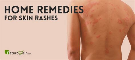 9 Home Remedies For Skin Rashes And Itching That Work Naturally