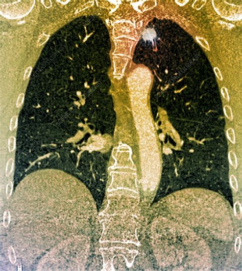 Lung Cancer Ct Scan Stock Image C0147052 Science Photo Library