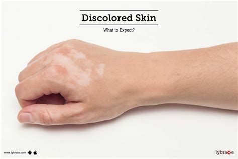 Discolored Skin What To Expect By Dr Anand Bhatia Lybrate