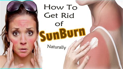 How To Treat Sunburn Naturally Home Remedies For Sunburn Treatment Youtube