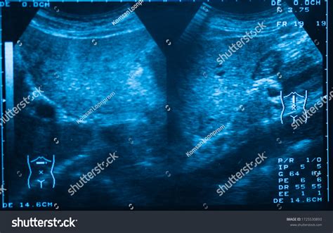 Whole Abdomen Ultrasound Scanhuman Film Xray Stock Photo 1725530893