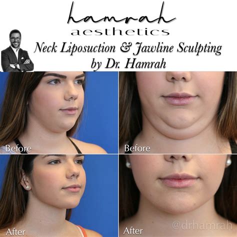 Neck And Chin Liposuction Nova Surgicare