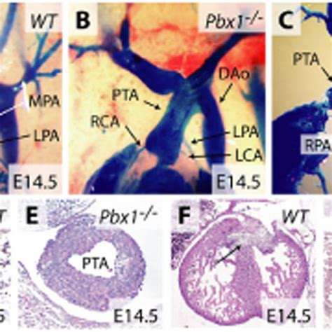 Msx2 Deficiency Rescues The Truncal Septation Defect Of Pbx1 Embryos