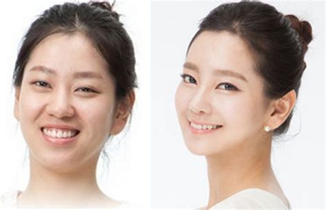 Before And After Photos Of Korean Plastic Surgery Part PICS Izismile Com