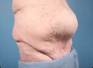 Abdominal wall hernias are typically classified by location or etiology. Midline Incisional Hernia Pictures | Hernia Before and ...