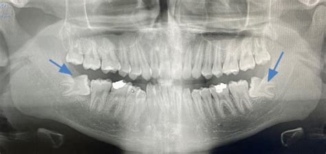 Dento Alveolar Surgery Miles Duncan