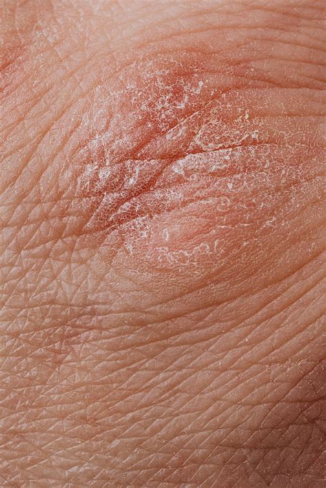 A Guide To Recognizing Morgellons Disease Chattanooga