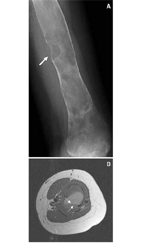 Aneurysmal Bone Cyst In Fd Aneurysmal Bone Cysts Are Uncommonly