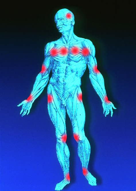 Male Figure Depicting Pain Points In Fibromyalgia Photograph By Alfred Pasieka Science Photo Library