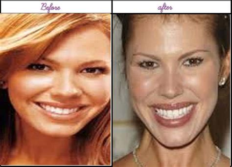 Look At After Before Plastic Surgery Pictures Of Nikki Cox Was She