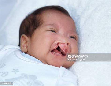 Cleft Lip Palate Photos And Premium High Res Pictures Getty Images