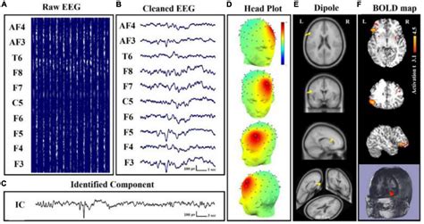 Frontiers Simultaneous Electroencephalography Functional Magnetic Resonance Imaging For