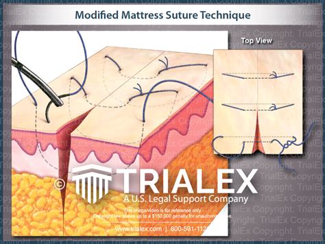 Modified Mattress Suture Technique Trialexhibits Inc