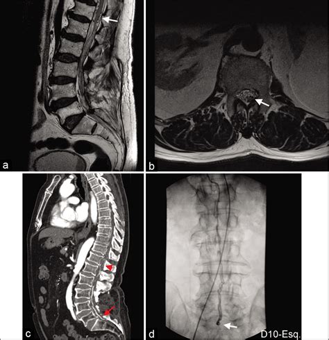 Case Report Conus Medullaris Syndrome From Spinal