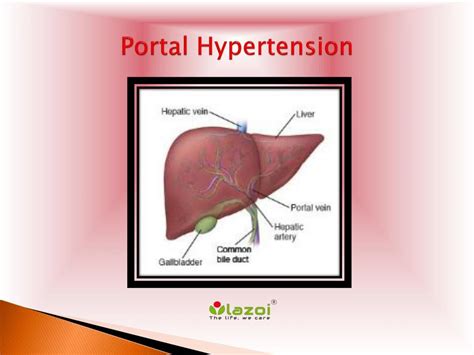 Ppt Portal Hypertension Causes Symptoms Daignosis Prevention And Treatment Powerpoint