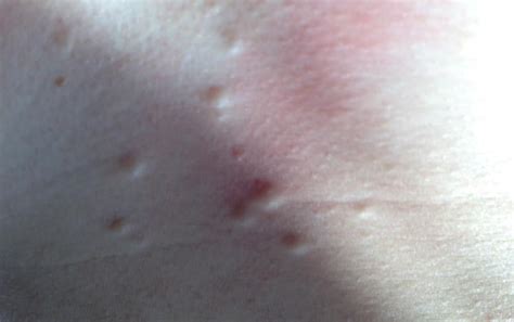 Small Lumps Under Skin On Chest What Are They Can You Please Help