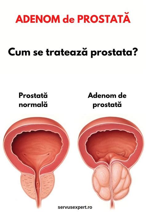 Adenom De Prostata