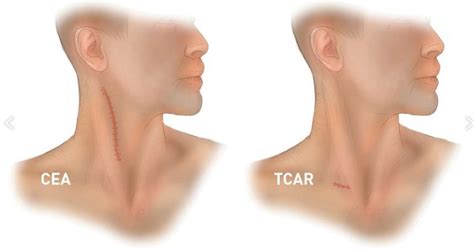 New Surgical Treatment For Carotid Disease Now Available Through