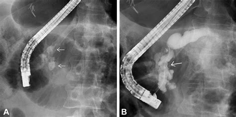 Ercp With Per Oral Pancreatoscopyguided Laser Lithotripsy For Calcific