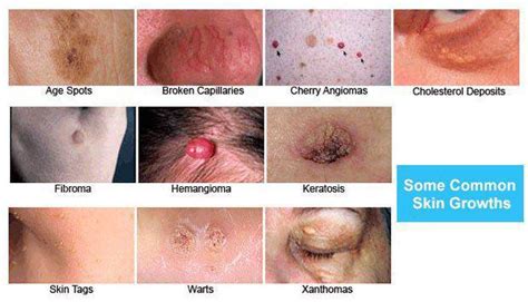 common skin growths a dermatologist s perspective