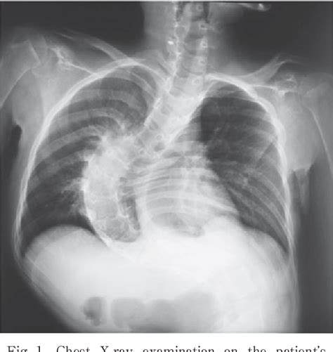 Figure From Fatal Tracheo Innominate Artery Fistula After Tracheostomy In A Patient With