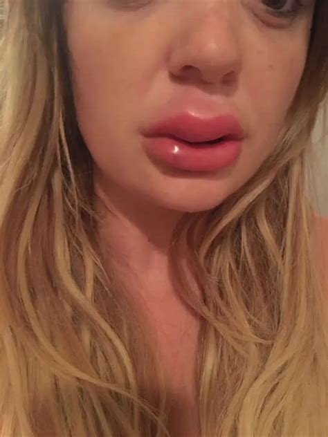 Mums Warning To Others After Lip Fillers Leave Her Infected And Swollen Nottinghamshire Live