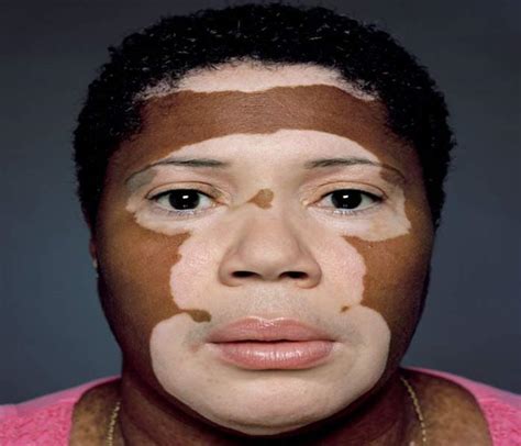 Skin Depigmentation Causes Symptoms Treatment Diagnosis And