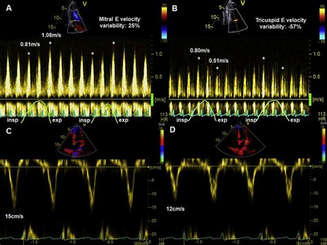 Pulsed Wave Doppler Derived Mitral A And Tricuspid B Early Inflow