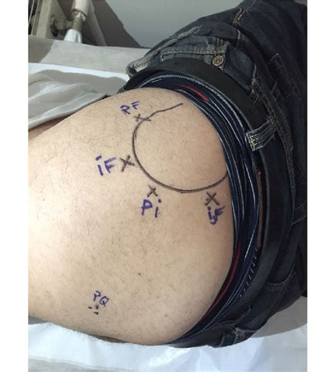 The Lateral Injection Points Anterolateral Pubofemoral Ligament