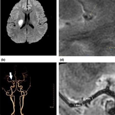 Artery‐to‐artery Embolism Stroke Mechanism In Ischemic Stroke Patients