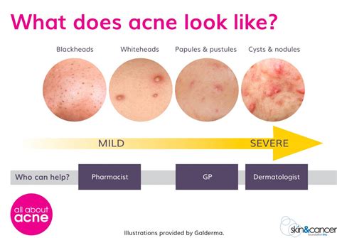 types of acne types of pimples all about acne