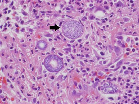 Coccidioidomycosis Valley Fever Pulmonology Advisor