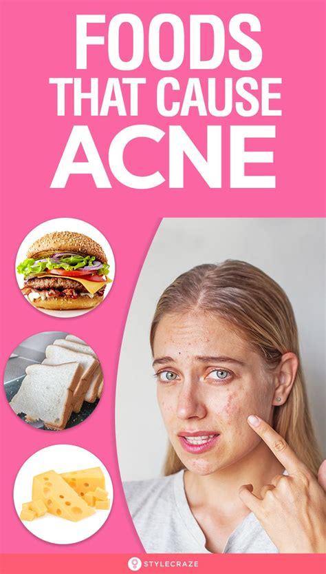 Top 10 Foods That Can Cause Acne Acne Causing Foods Beauty Hacks