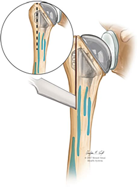 58 Stem Removal Humeral Osteotomy Musculoskeletal Key