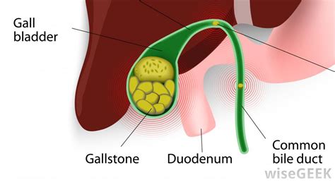 Best Gallbladder Surgeon And Gallstone Surgery Cost In Bangalore