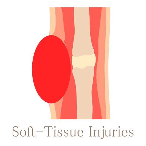 What Is A Soft Tissue Injury