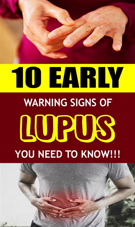 10 Early Warning Signs Of Lupus You Need To Know Natural Beauty
