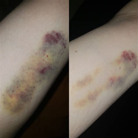 When People Said The Bruising Could Be Pretty Bad They Werent Kidding
