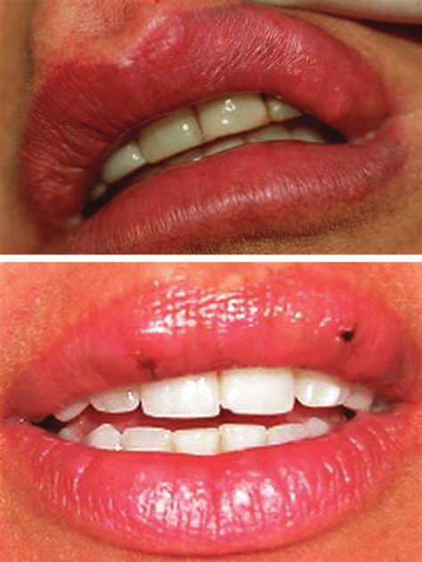 Above Small Lumps In The Lip After Injection Of Radiesse Into The