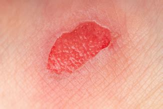Granulation Tissue In Wound Care Identification Function And