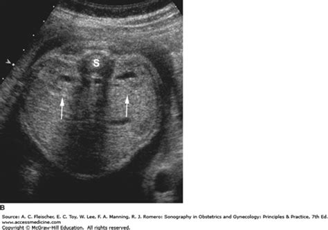 The Fetal Genitourinary System Sonography In Obstetrics And