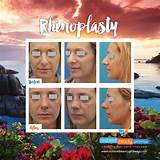 Payment Plans For Rhinoplasty