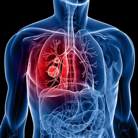 Interstitial Lung Disease Interstitial Pneumonia Symptoms Treatment