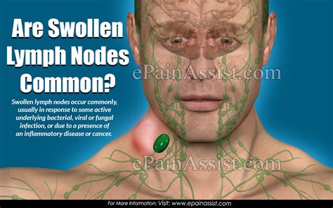 Painful Swollen Lymph Nodes Turklasopa