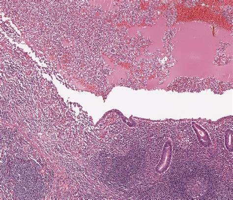 Diseases of the heart, philadelphia, 1966; el-IPH: Akute Appendizitis · Kurs Allgemeinpathologie